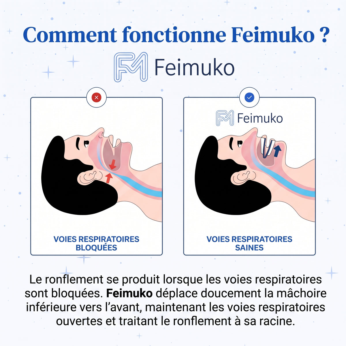 Feimuko Pro – Gouttière Anti-Ronflement